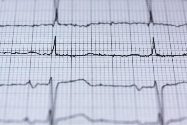 What is ECG and its types ?